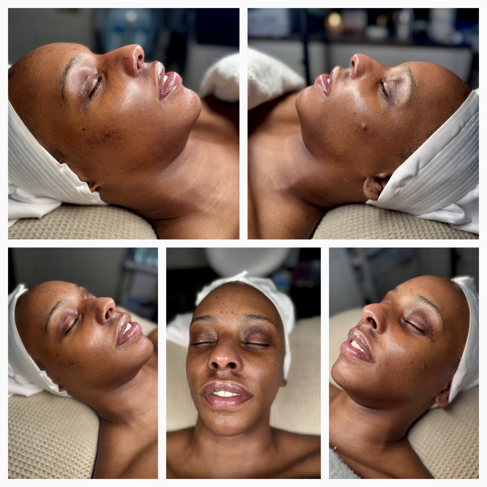 Client results at WilKay Wellness & Aesthetics, Phoenix AZ – photo 9