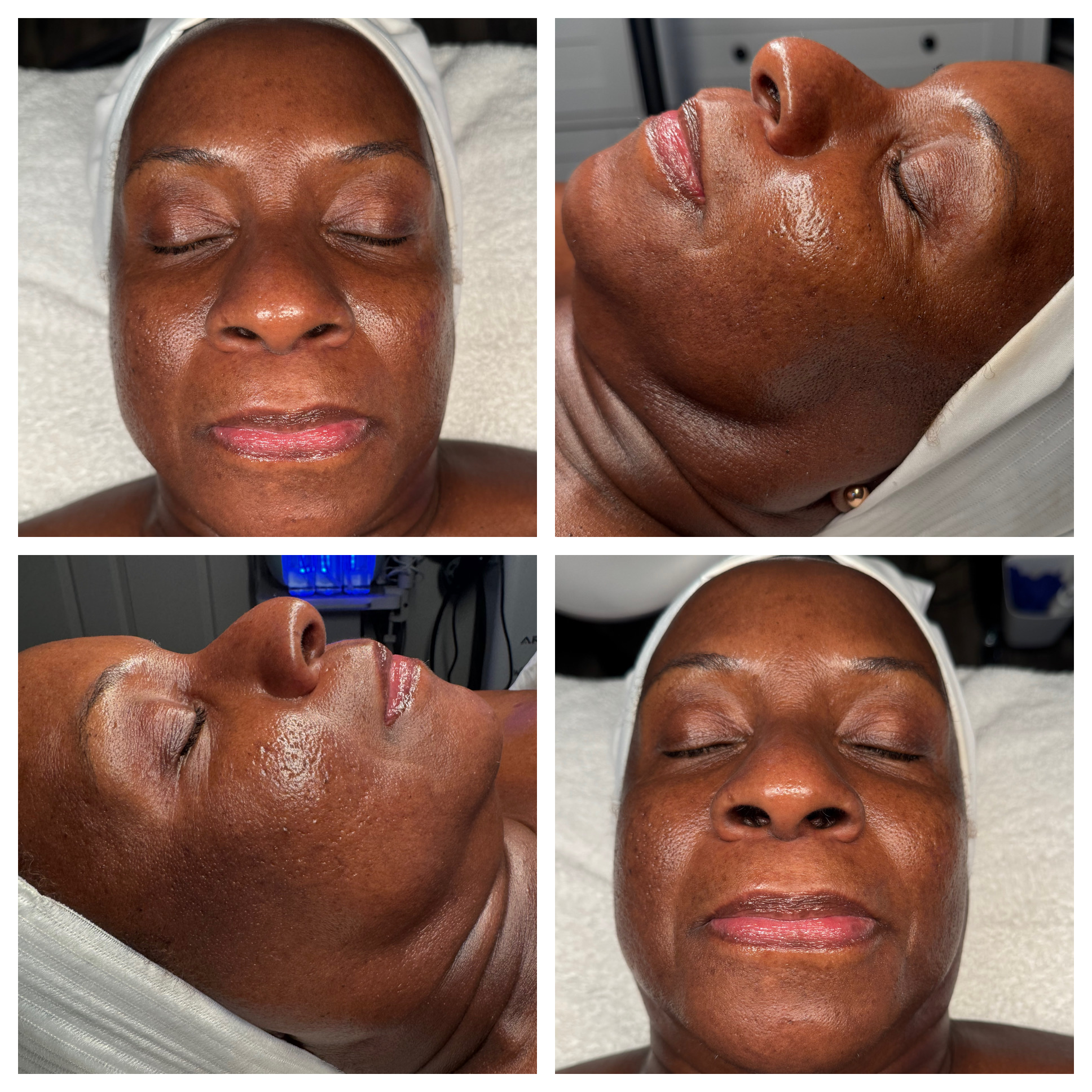 Client results at WilKay Wellness & Aesthetics, Phoenix AZ – photo 10