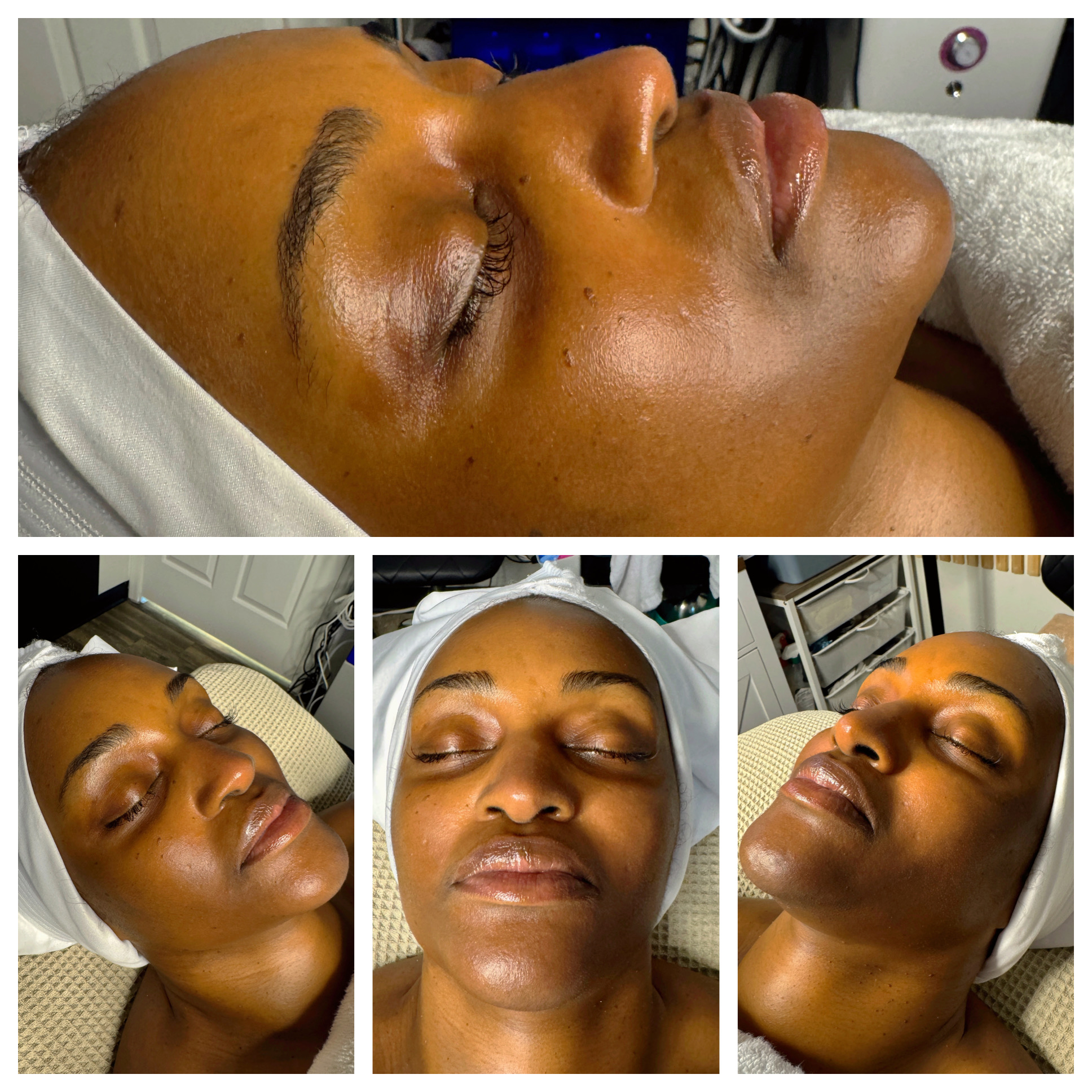 Client results at WilKay Wellness & Aesthetics, Phoenix AZ – photo 11