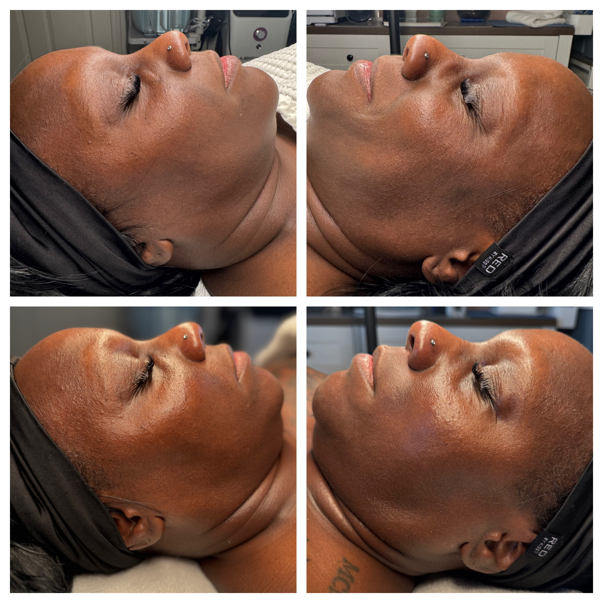 Client results at WilKay Wellness & Aesthetics, Phoenix AZ – photo 14