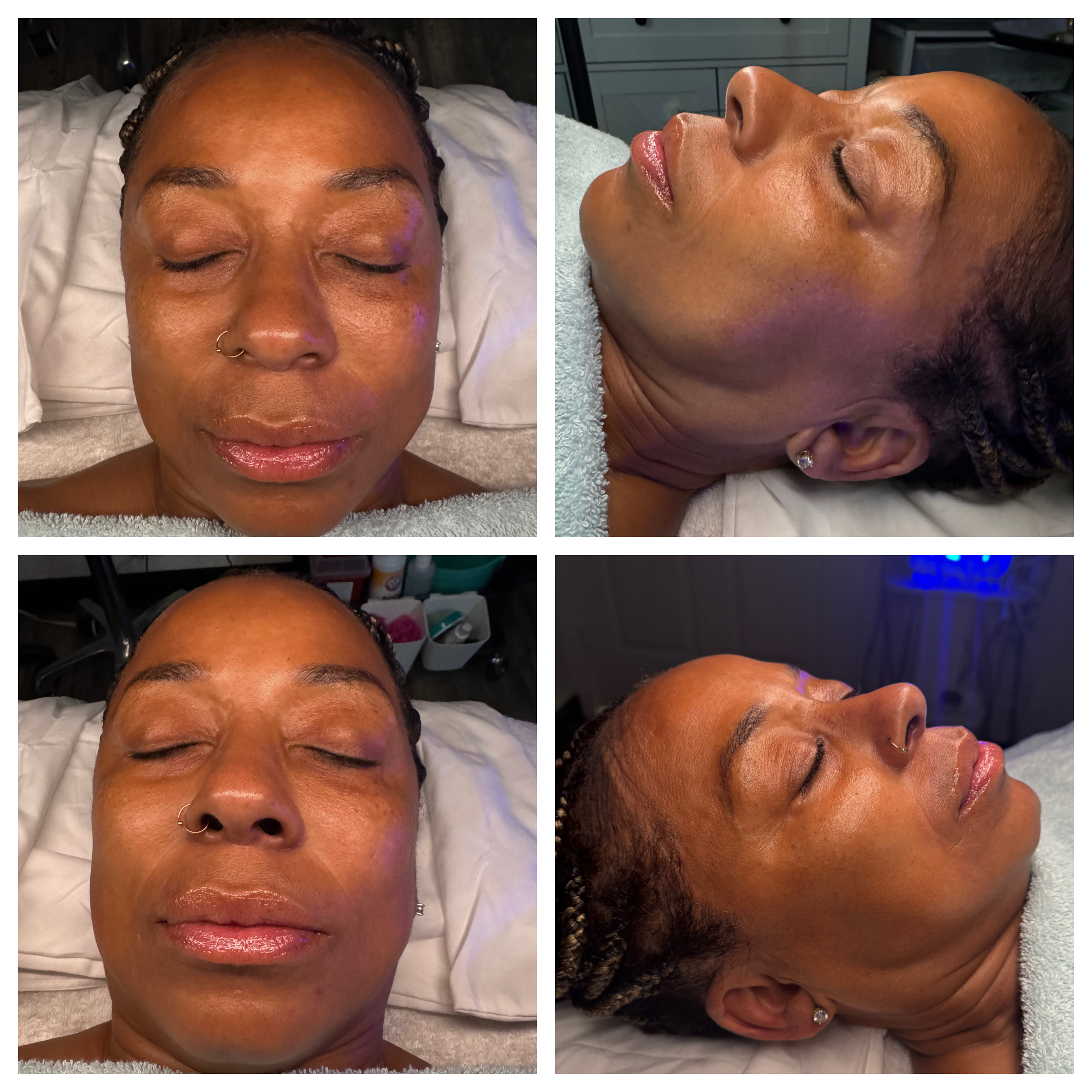 Client results at WilKay Wellness & Aesthetics, Phoenix AZ – photo 15