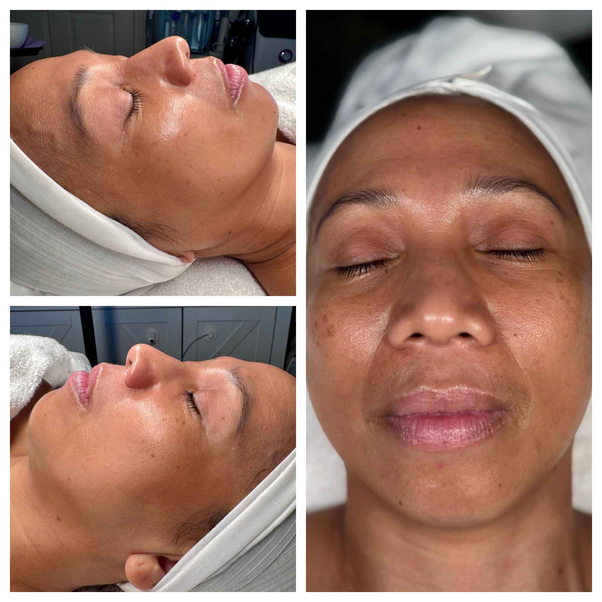 Client results at WilKay Wellness & Aesthetics, Phoenix AZ – photo 16