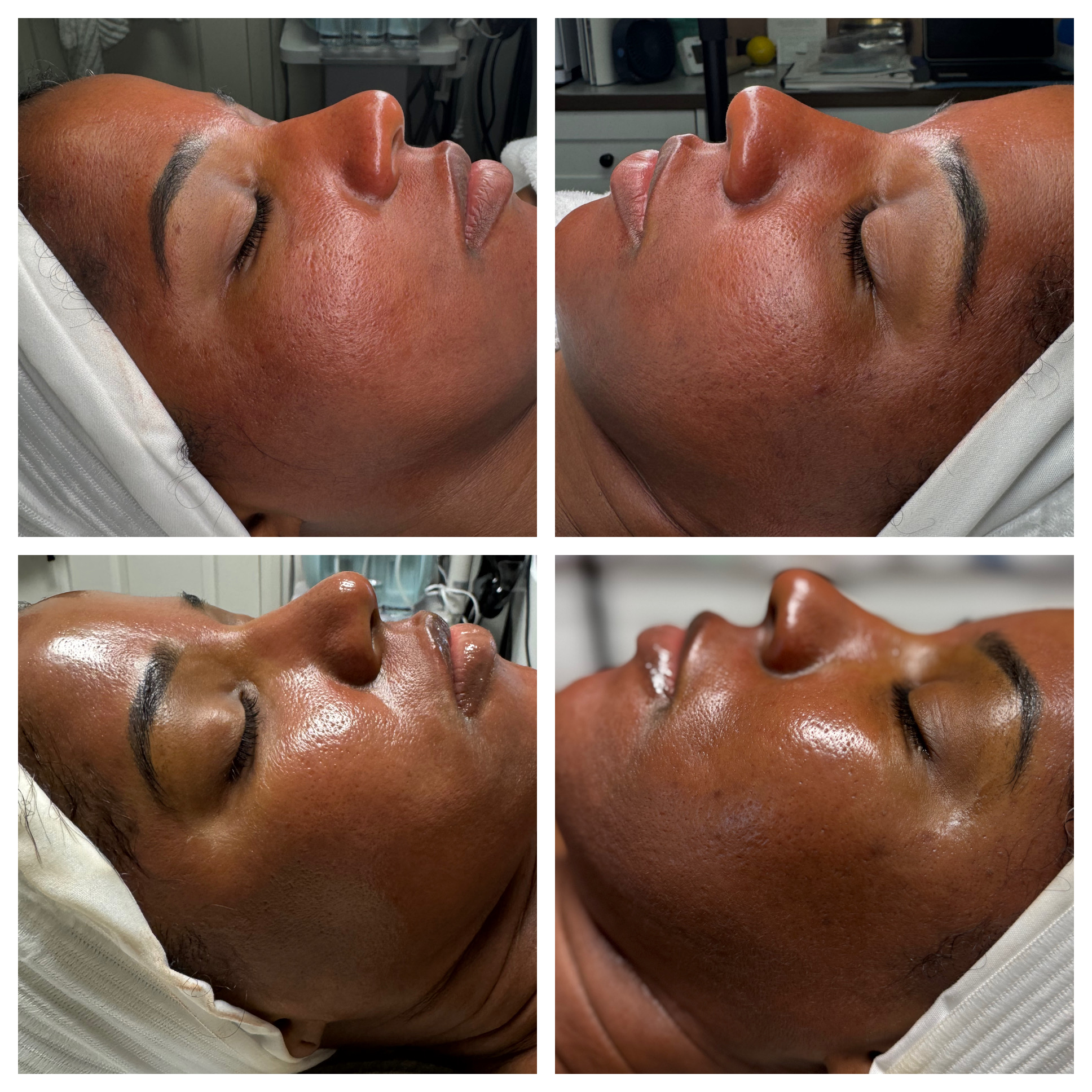 Client results at WilKay Wellness & Aesthetics, Phoenix AZ – photo 18