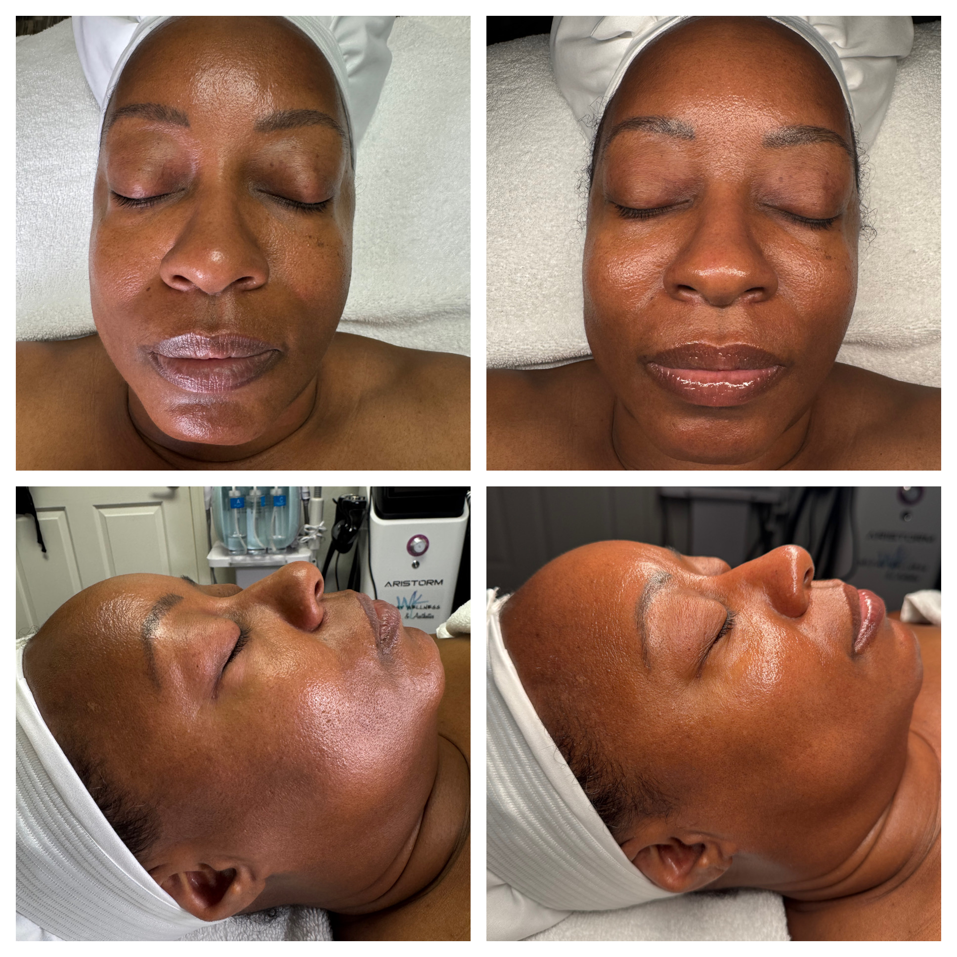 Client results at WilKay Wellness & Aesthetics, Phoenix AZ – photo 19