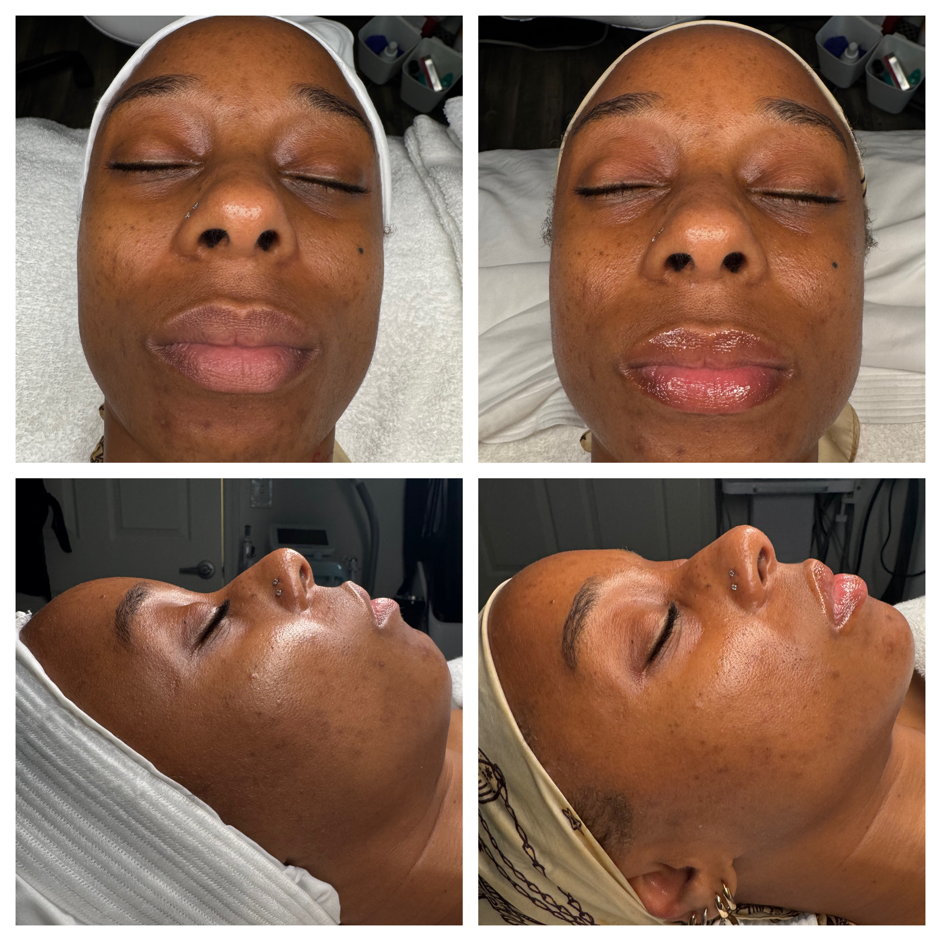 Client results at WilKay Wellness & Aesthetics, Phoenix AZ – photo 20