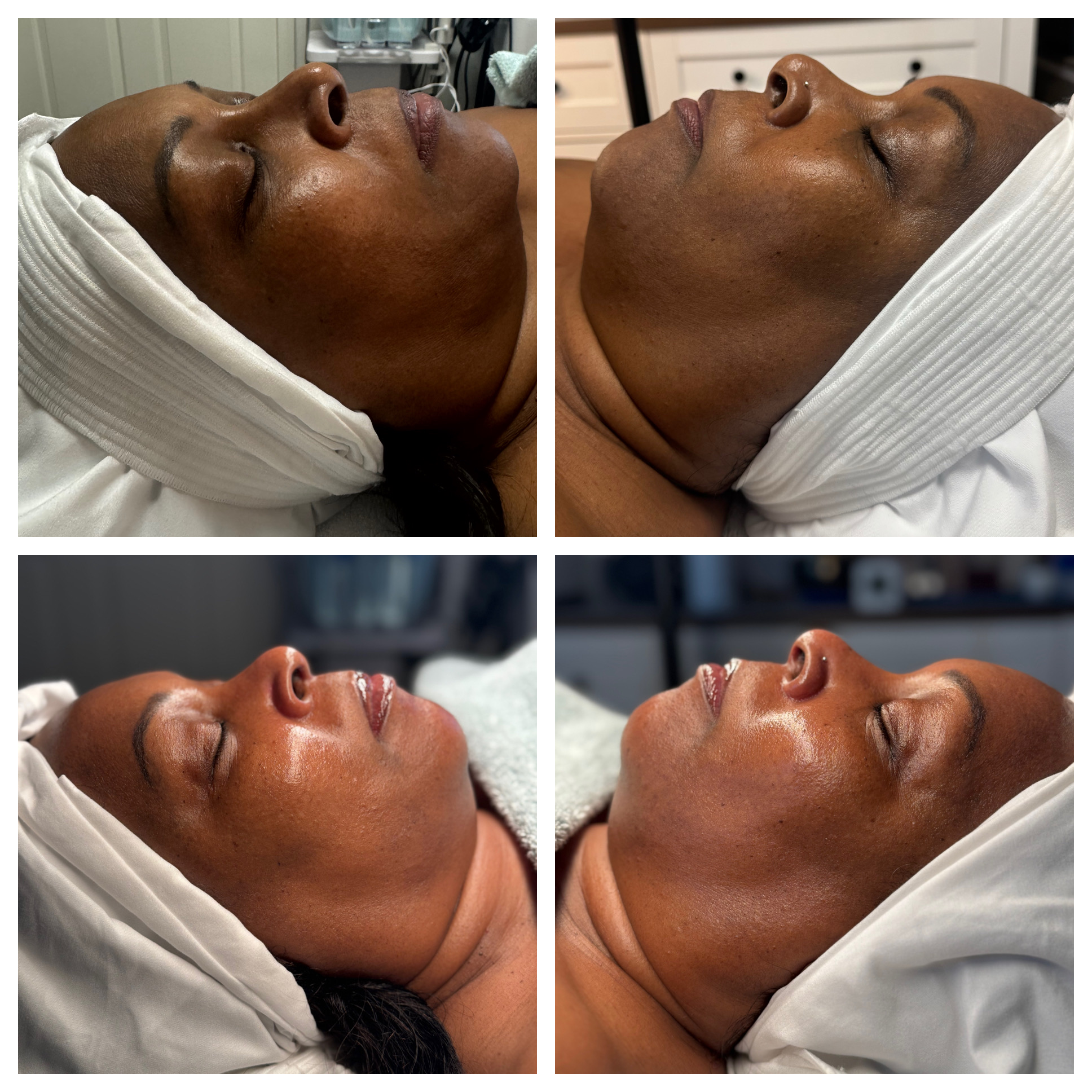 Client results at WilKay Wellness & Aesthetics, Phoenix AZ – photo 21