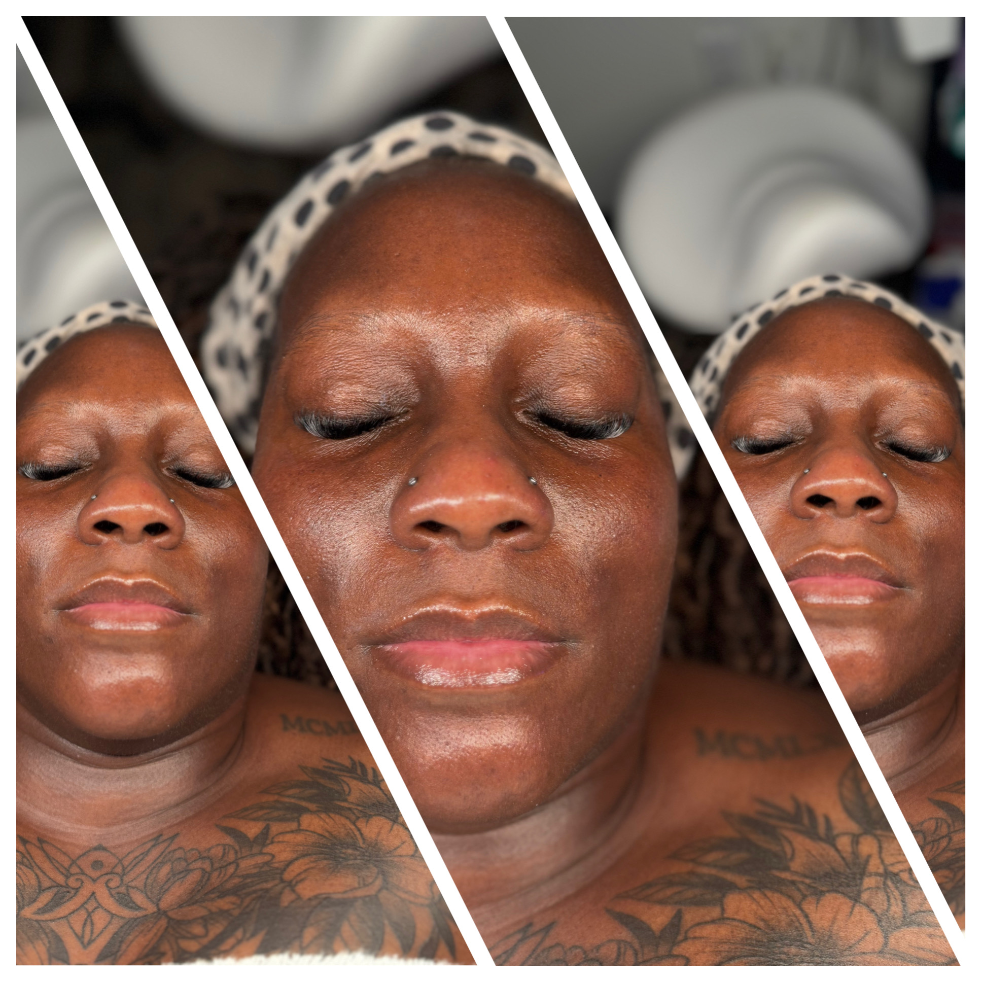 Client results at WilKay Wellness & Aesthetics, Phoenix AZ – photo 22