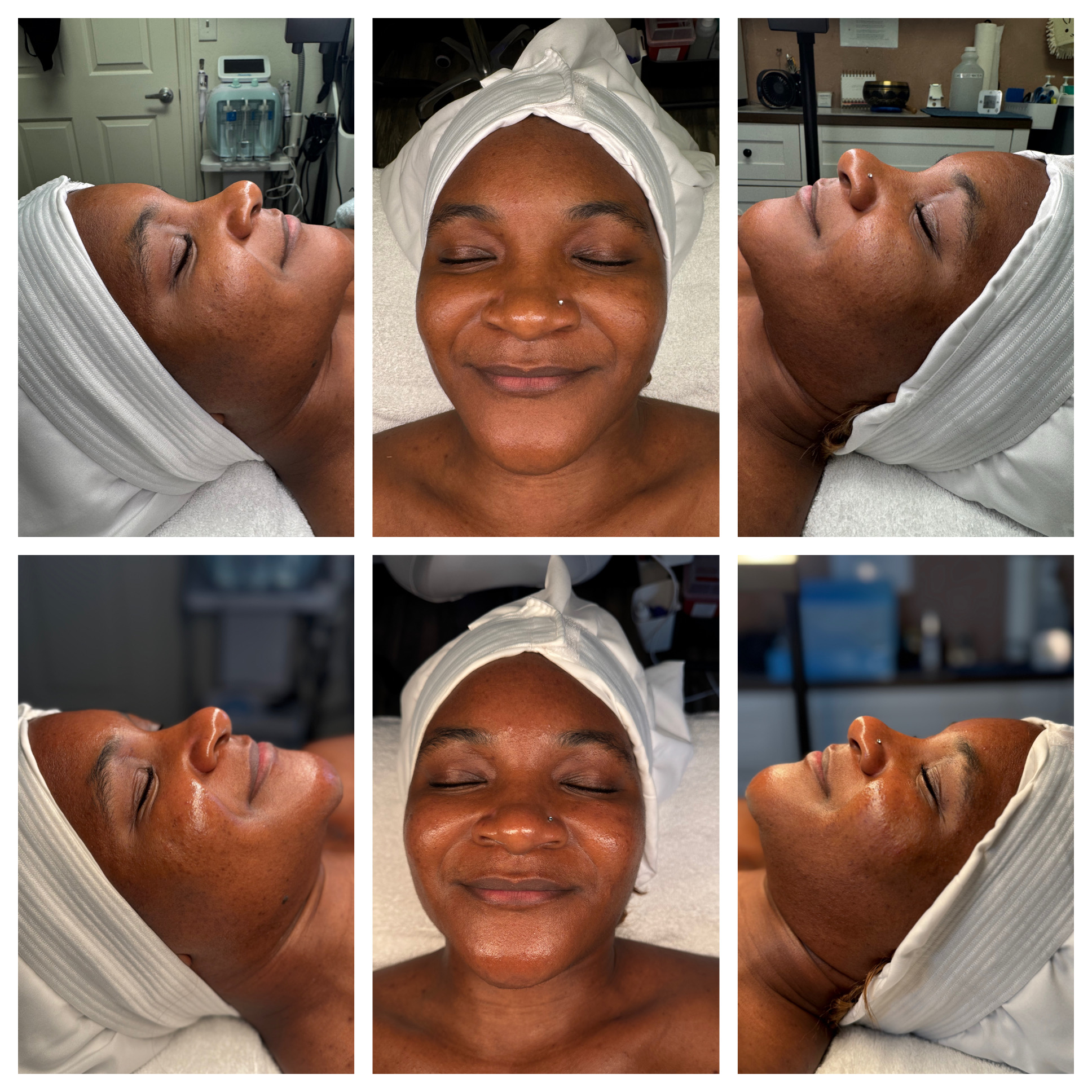 Client results at WilKay Wellness & Aesthetics, Phoenix AZ – photo 24