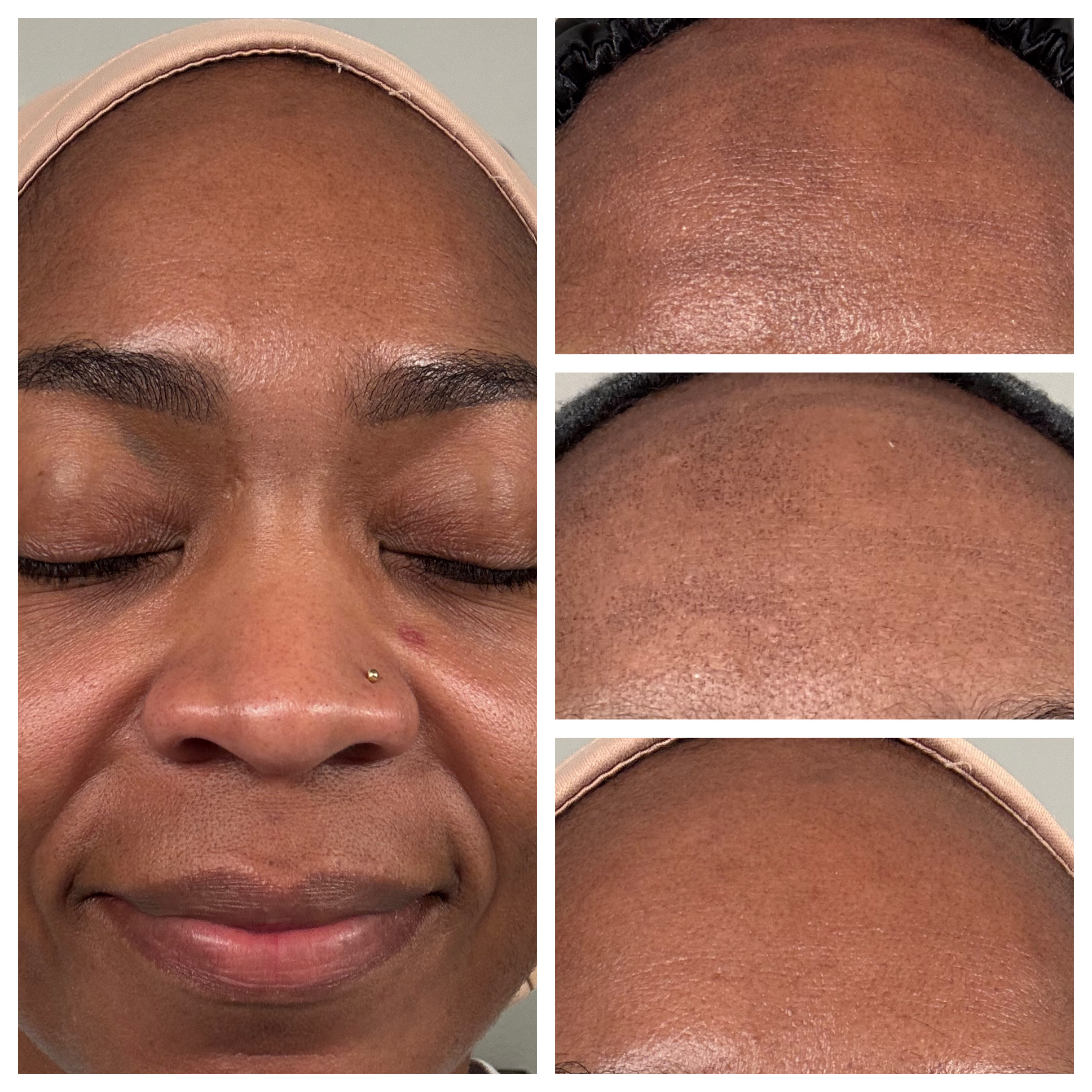 Client results at WilKay Wellness & Aesthetics, Phoenix AZ – photo 25