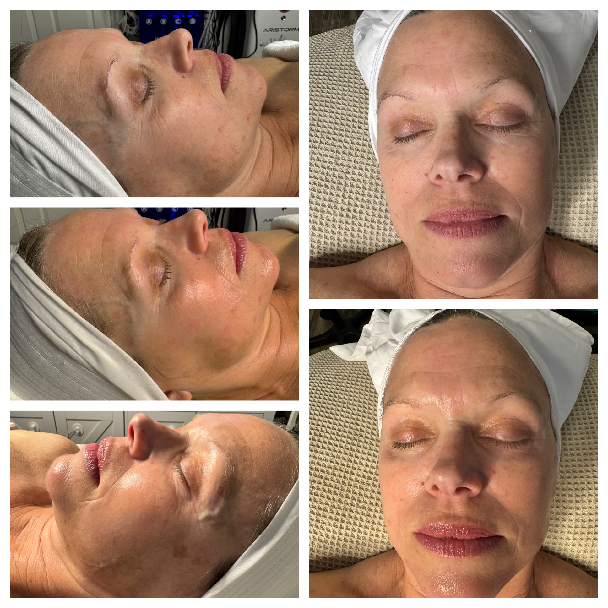 Client results at WilKay Wellness & Aesthetics, Phoenix AZ – photo 26