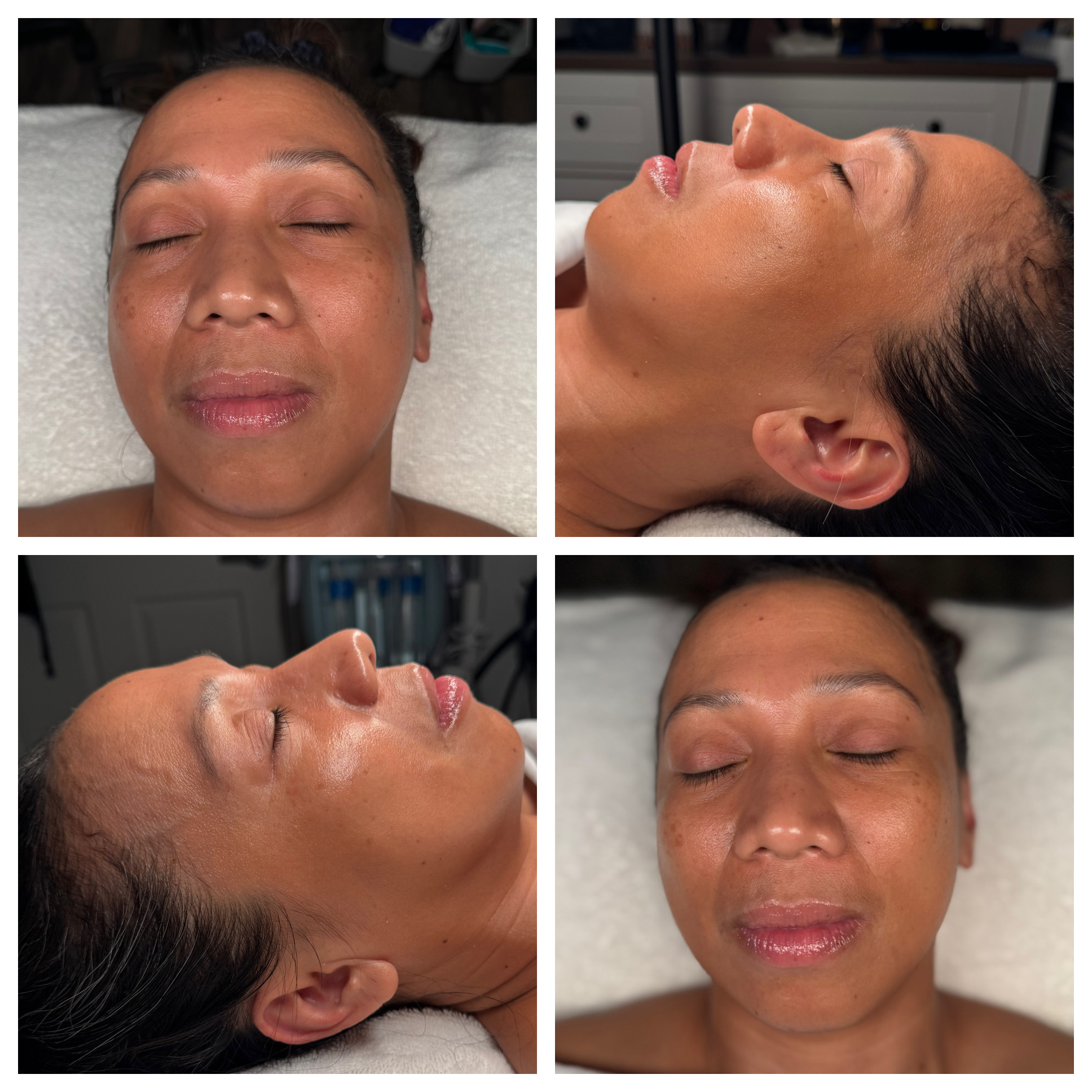 Client results at WilKay Wellness & Aesthetics, Phoenix AZ – photo 27