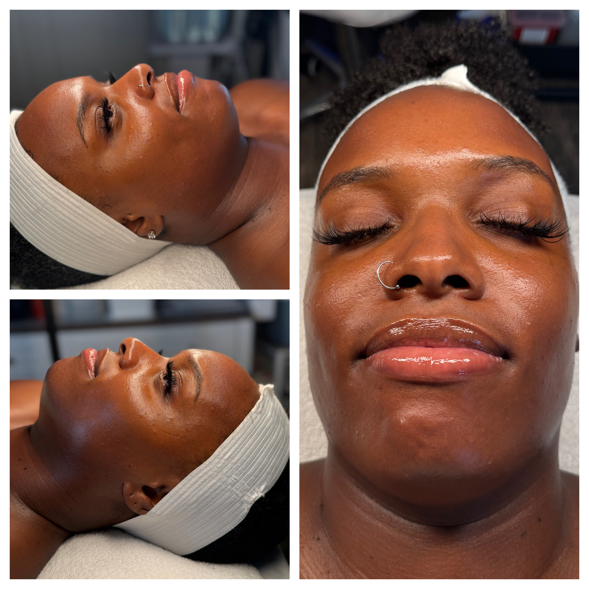 Client results at WilKay Wellness & Aesthetics, Phoenix AZ – photo 28