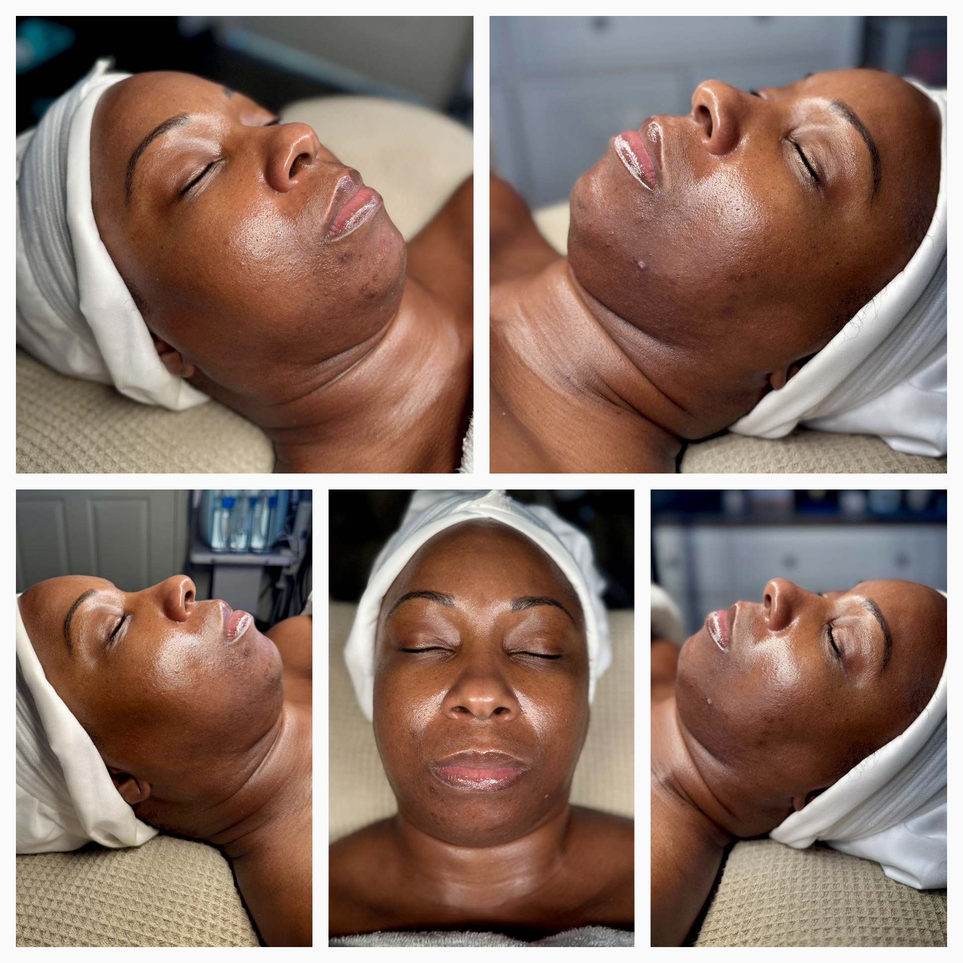 Client results at WilKay Wellness & Aesthetics, Phoenix AZ – photo 29