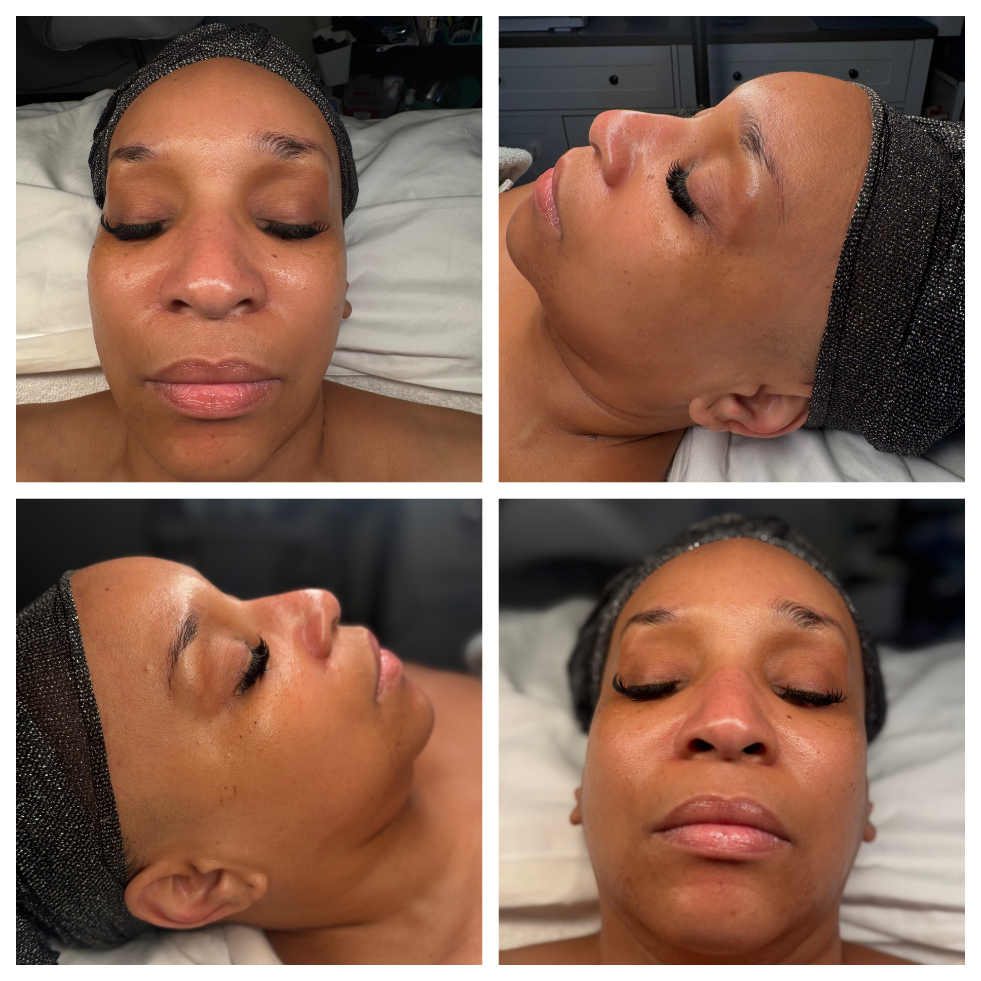 Client results at WilKay Wellness & Aesthetics, Phoenix AZ – photo 30