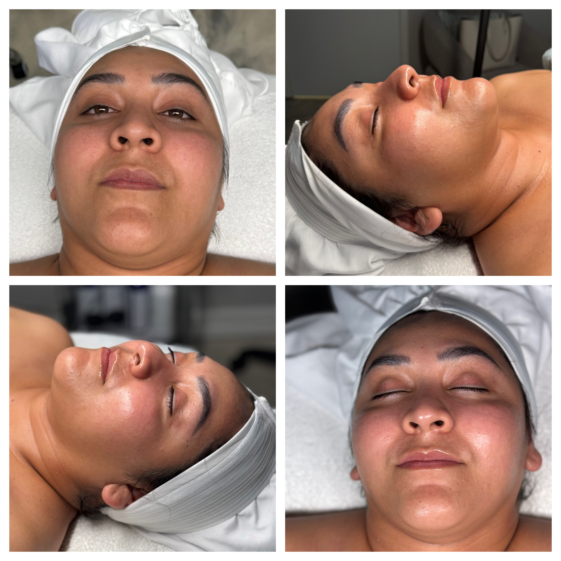 Client results at WilKay Wellness & Aesthetics, Phoenix AZ – photo 31