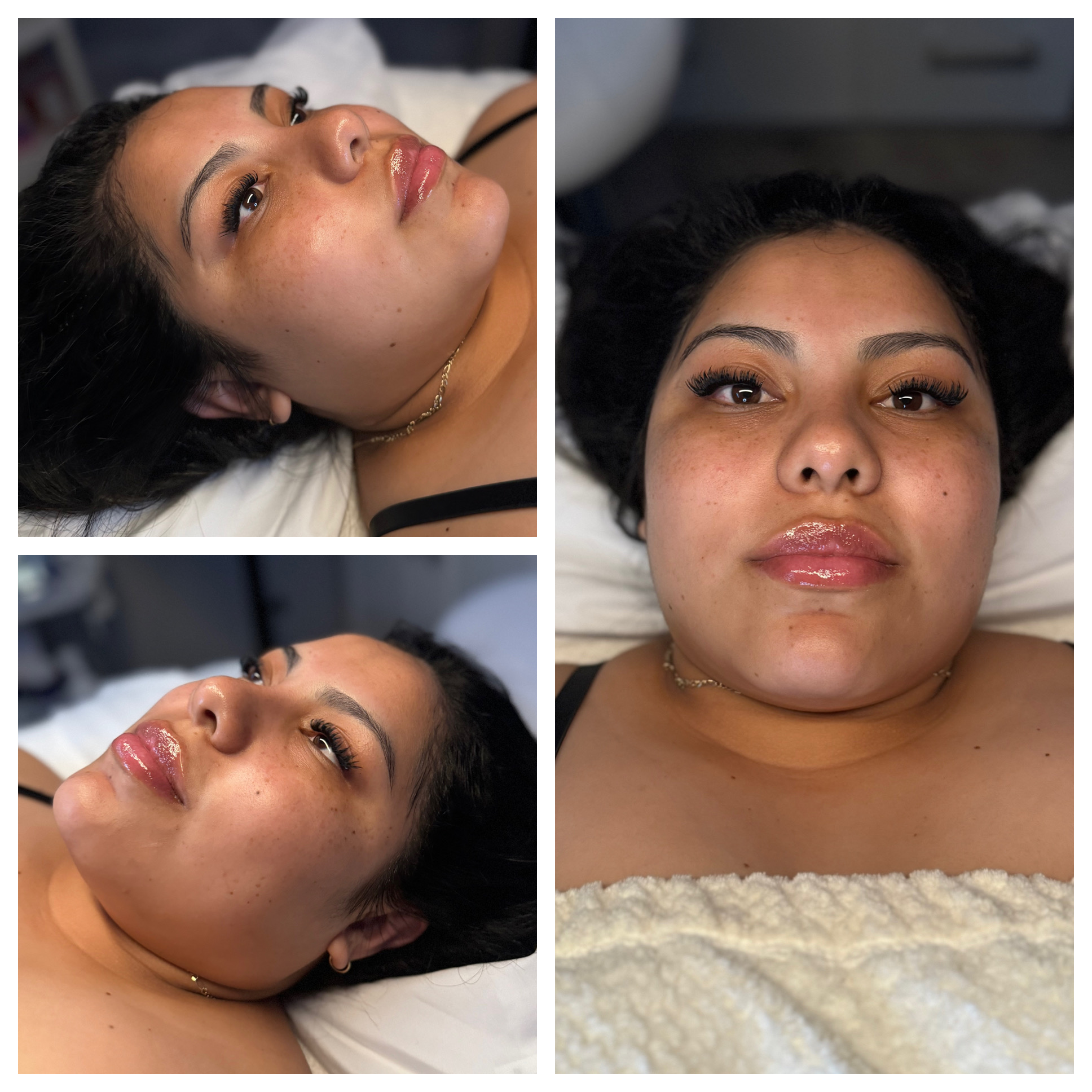 Client results at WilKay Wellness & Aesthetics, Phoenix AZ – photo 32