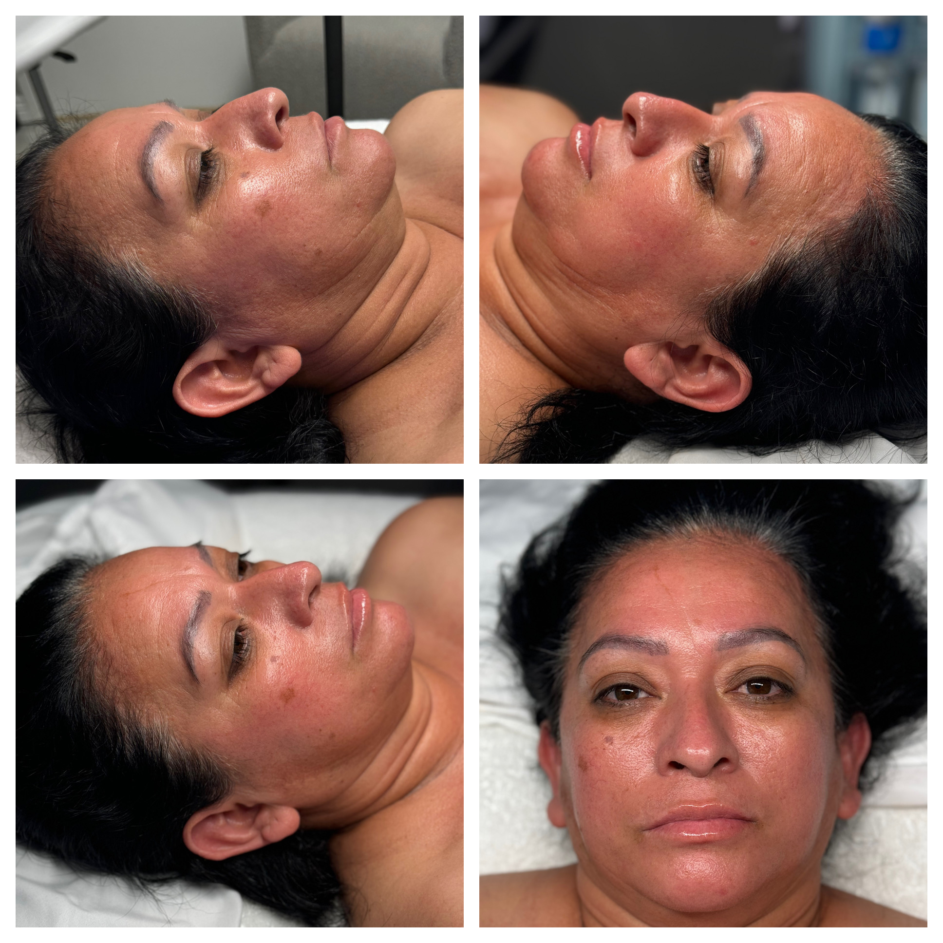 Client results at WilKay Wellness & Aesthetics, Phoenix AZ – photo 33