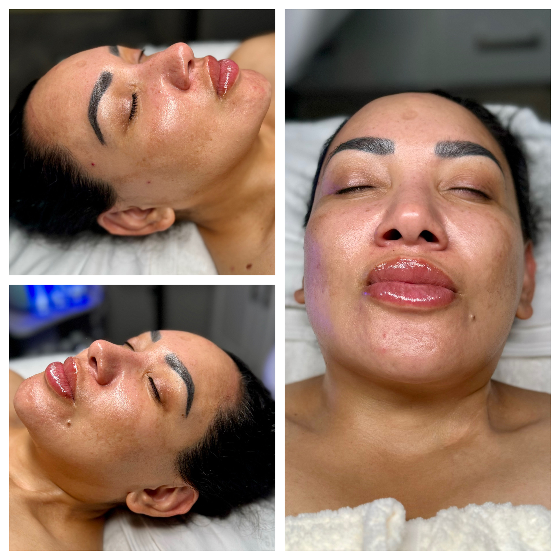 Client results at WilKay Wellness & Aesthetics, Phoenix AZ – photo 34