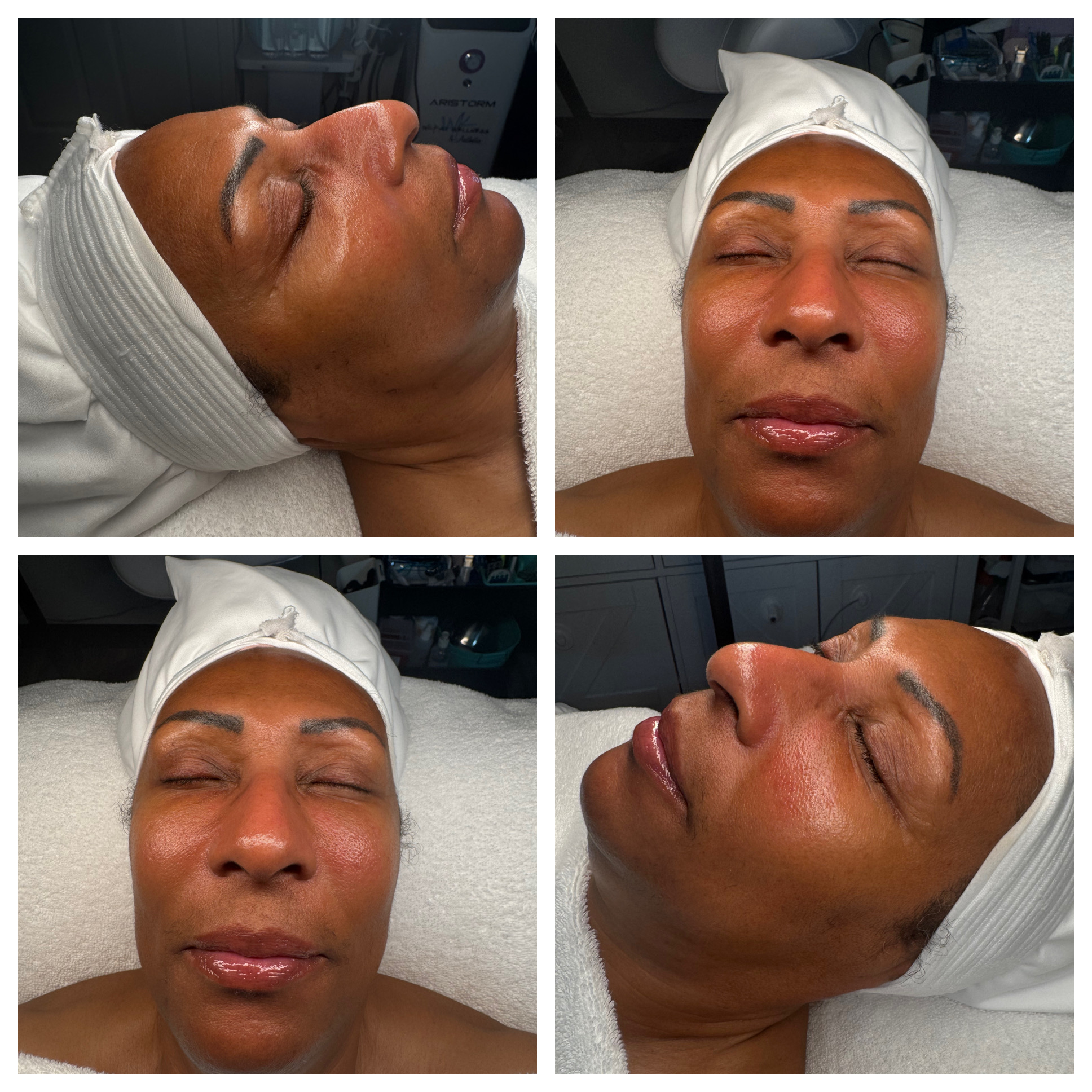 Client results at WilKay Wellness & Aesthetics, Phoenix AZ – photo 35