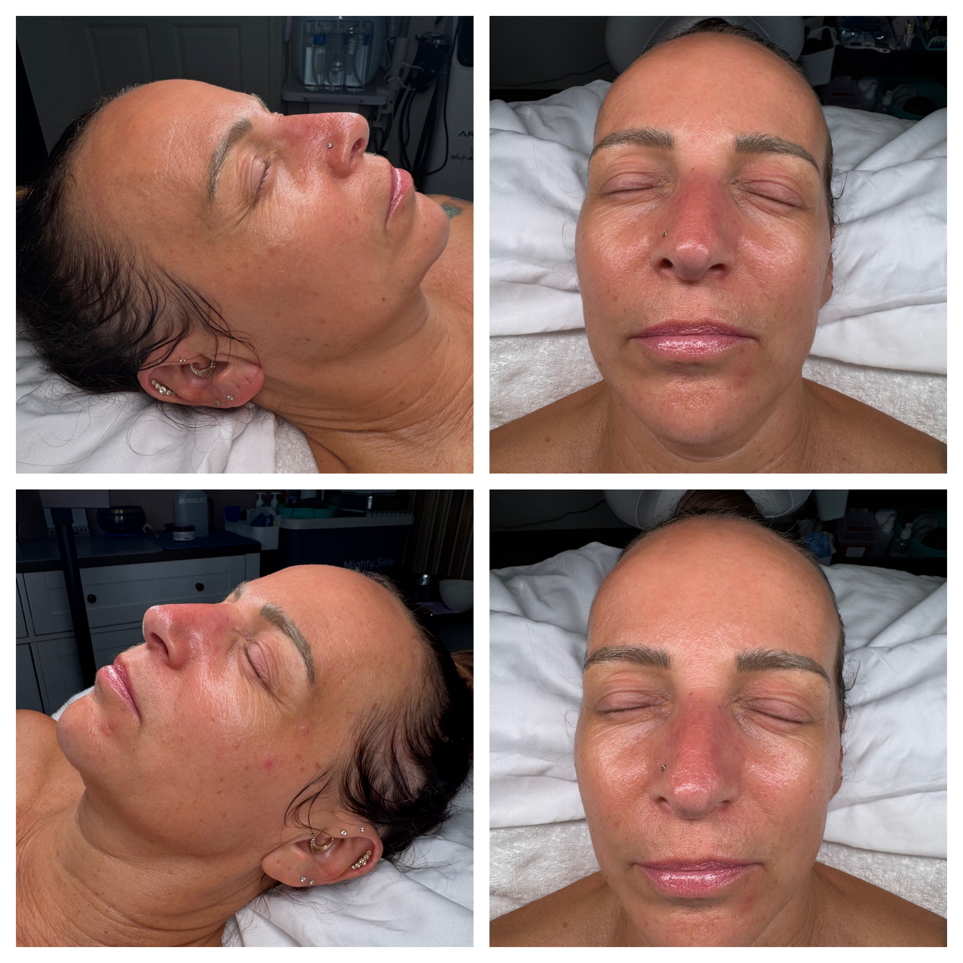 Client results at WilKay Wellness & Aesthetics, Phoenix AZ – photo 36
