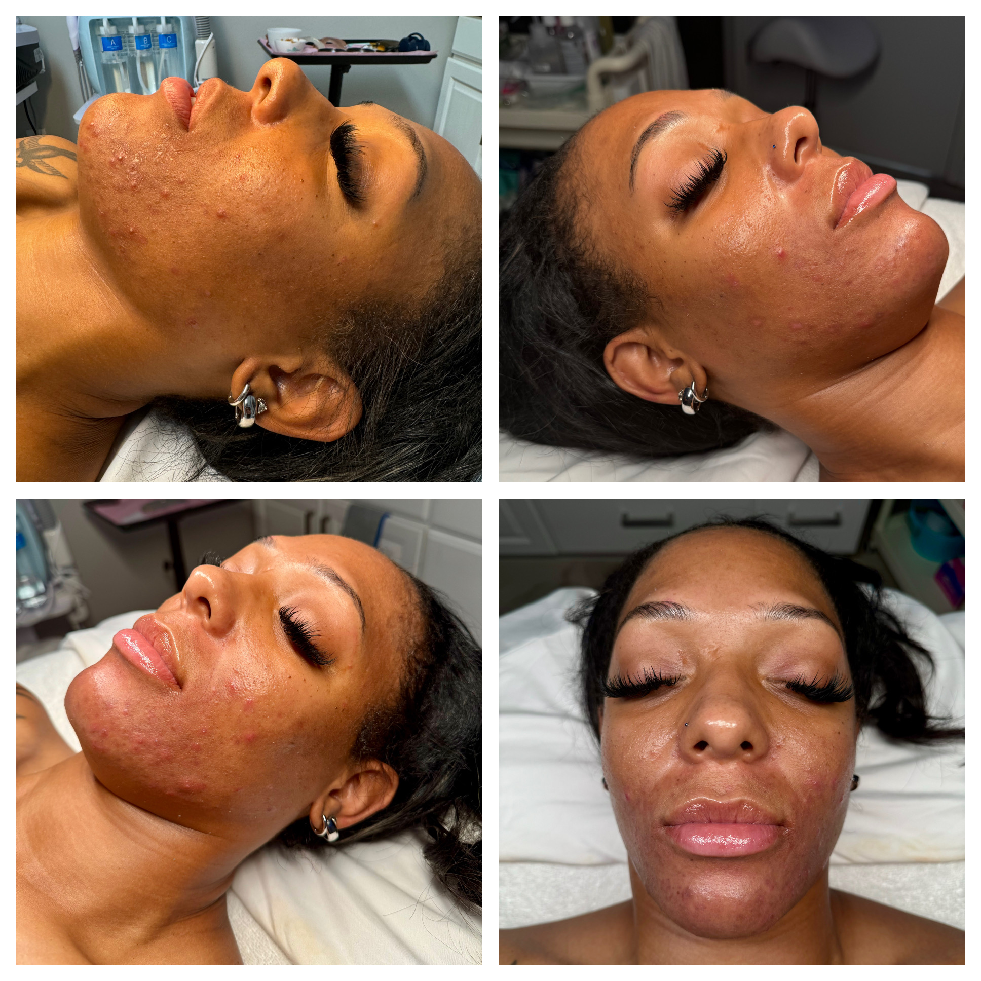 Client results at WilKay Wellness & Aesthetics, Phoenix AZ – photo 37