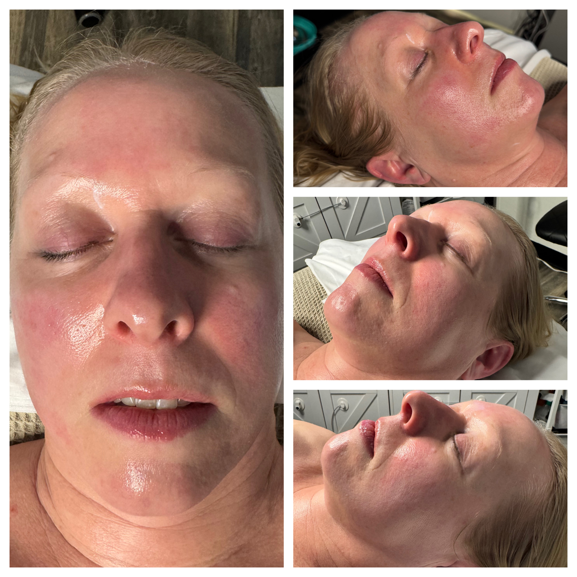 Client results at WilKay Wellness & Aesthetics, Phoenix AZ – photo 38