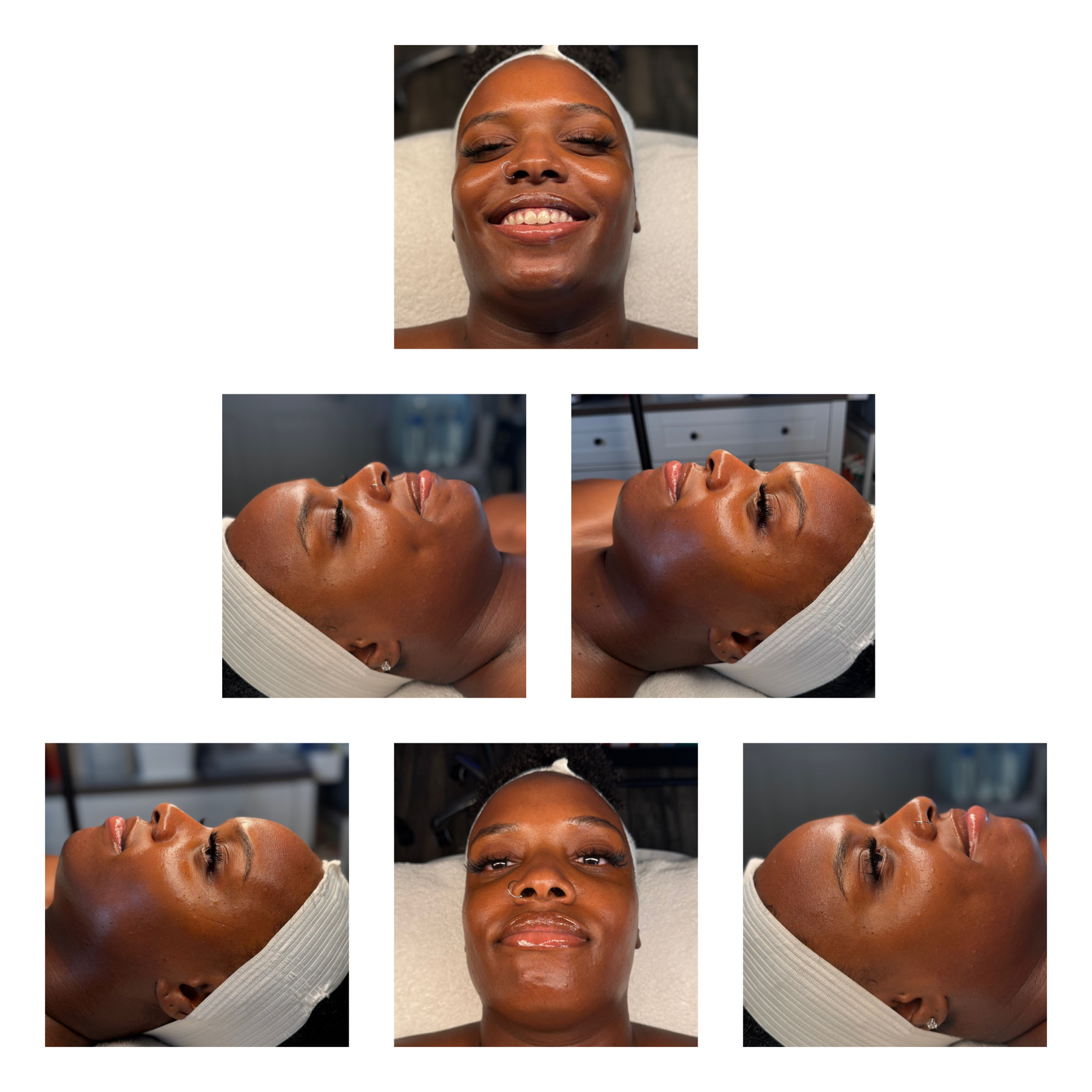 Client results at WilKay Wellness & Aesthetics, Phoenix AZ – photo 39
