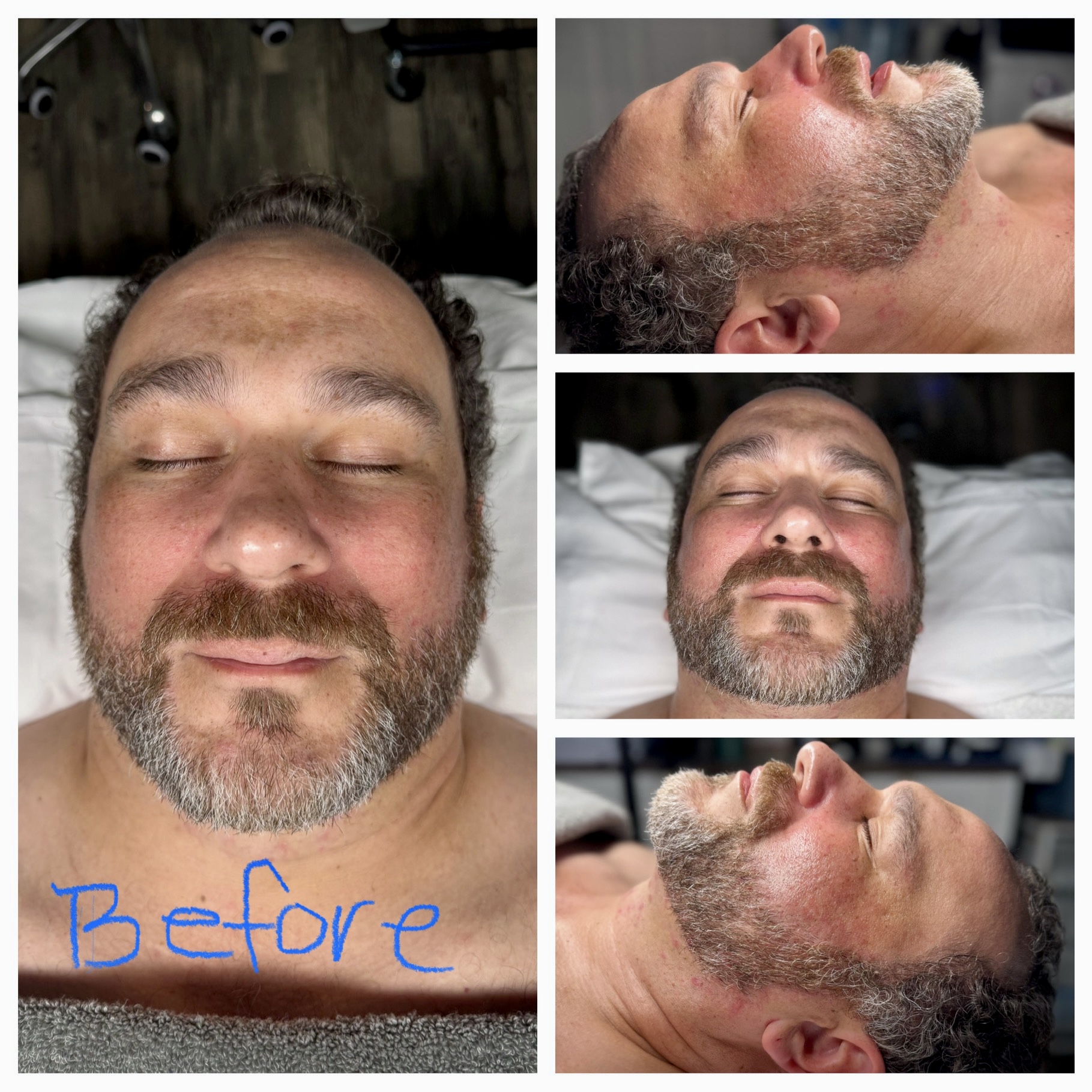 Client results at WilKay Wellness & Aesthetics, Phoenix AZ – photo 4